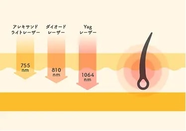 じぶんクリニック ソプラノチタニウムの波長の長さ