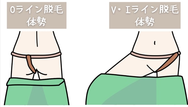 スキミークリニックのVIO脱毛の体勢