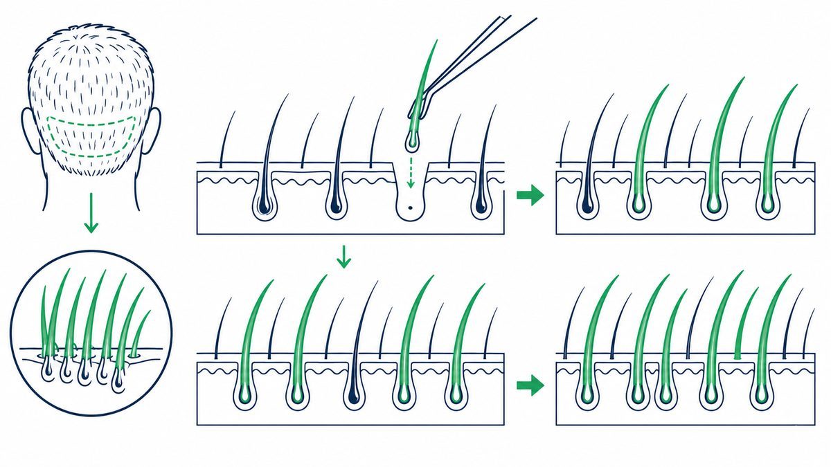 後頭部から採取した毛根を、既存毛の隙間に移植して密度を上げる自毛植毛の流れを示した図