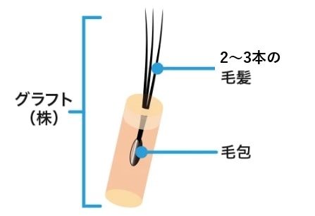 1株(グラフト)は毛穴の単位で、2〜3本の毛髪と毛包で構成されることを示した図