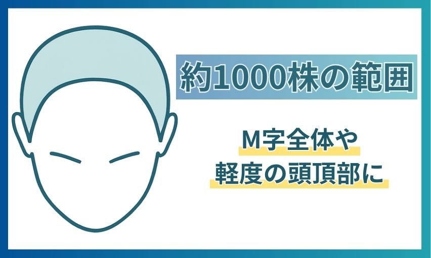 約1,000株でカバーできる範囲。M字全体や軽度の頭頂部にあたることを示した図