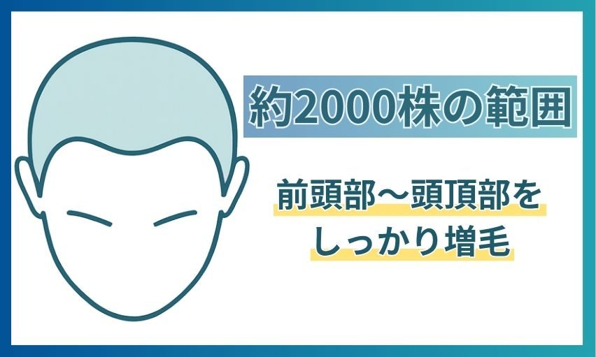 約2,000株でカバーできる範囲。前頭部から頭頂部までの広い範囲にあたることを示した図